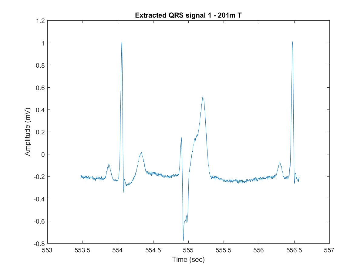 Extracted QRS window for Trigeminy Ventricular arrhythmia sample