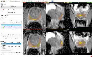 QIN-Prostate-Repeatability